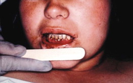 Gingival Manifestion of Argentine HF