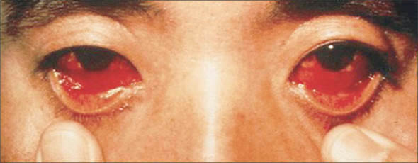 Ocular Manifestion of Argentine HF